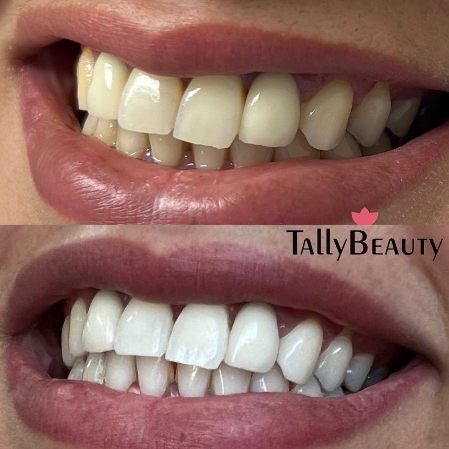 Teeth Whitening before and after, done at Tally Beauty